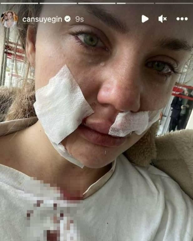 Cansu Yeğin blev angrebet af en hund