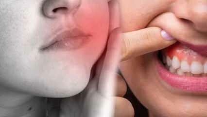 Hvad forårsager en tandbyld? Hvad er symptomerne og i hvor mange dage? Naturlige løsninger på tandbylder...