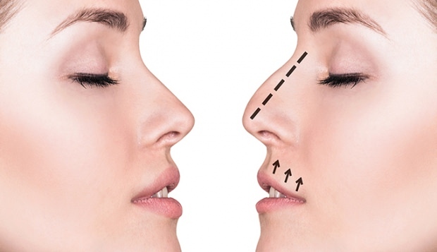 Hvordan udføres en næseoperation? I hvilke tilfælde udføres en næseoperation?