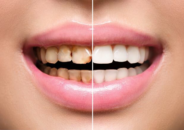Som et resultat af usund ernæring forekommer både misfarvning af tænder og tab af tænder