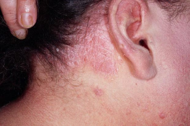 Hvad er symptomerne på seboreisk dermatitis, og hvem vises den? Fødevarer, der udløser sygdommen