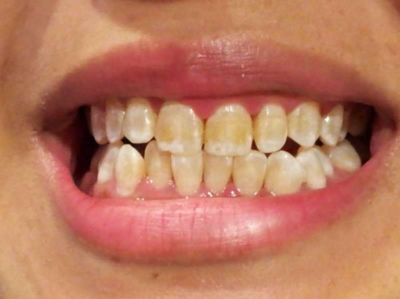 tandbillede af en person, hvis tænder begynder at blive mørkere