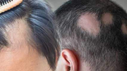Hvad er ringorm (Alopecia areata)? Hvad er ringormsymptomer? Effektive løsninger til ringorm