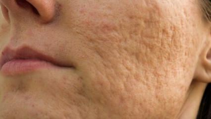 Hvordan går acne-ar i ansigtet? Maskeopskrifter, der fjerner acne-ar