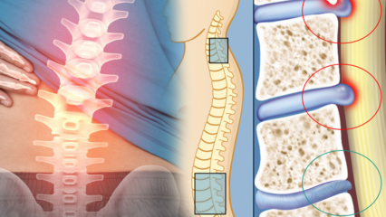 Hvad er rygmarvsnedsættelse? Hvad er symptomerne på rygmarvsindskrænkning? Er der en kur mod indsnævring af rygmarven?