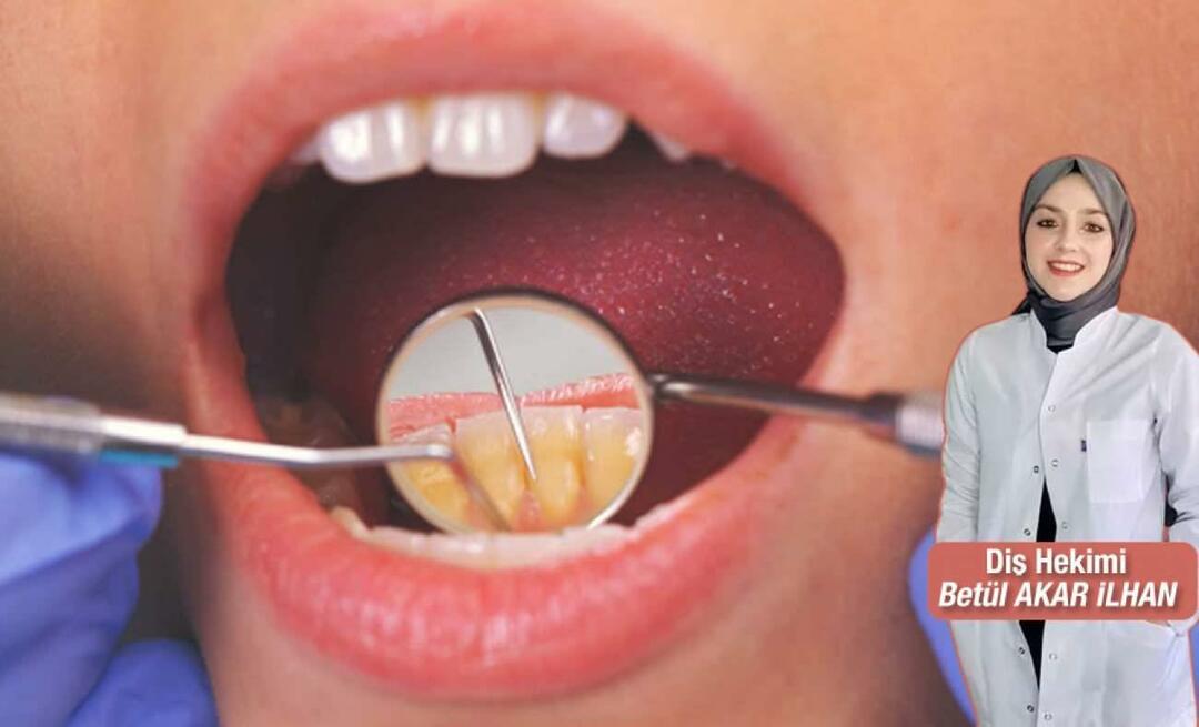 Hvad skal man gøre for at undgå tandsten? Hvad er fordelene ved tandskalering?