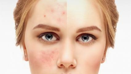 De mest effektive og bedste acne reliefcremer på apoteket 2021