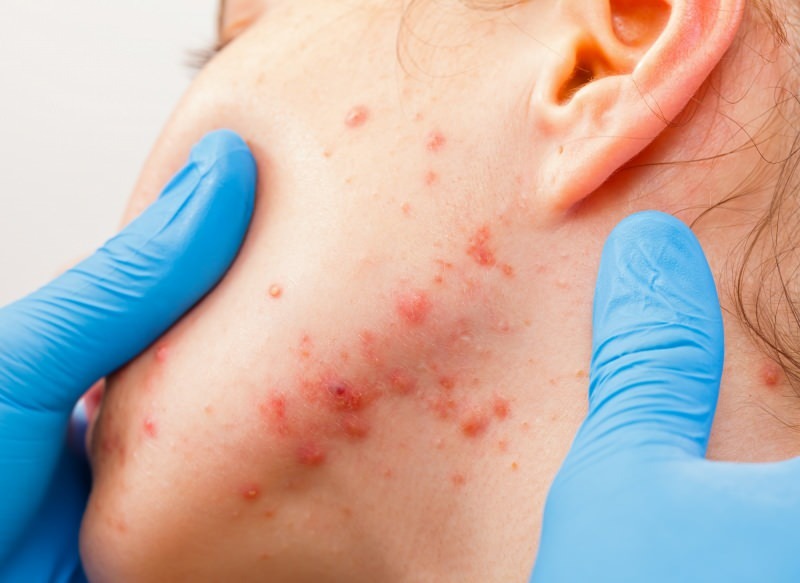 virussen forårsager blærer på hudoverfladen