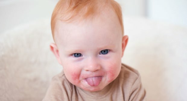 Opmærksomhed hos babyer med røde kinder! Slapped kind syndrom og dets symptomer