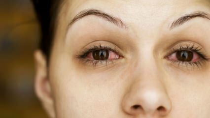 Hvad er konjunktivitis (øjeninfluenza), og hvad er dens symptomer? Hvordan overføres konjunktivitis?