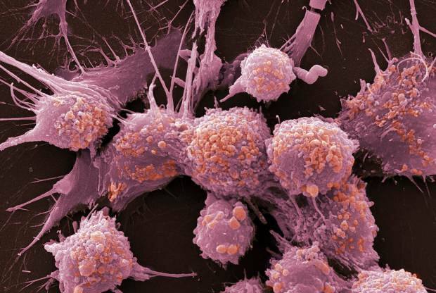 Hvad er kræft, og hvad er dens symptomer? Hvor mange typer kræft er der? Hvordan forhindres kræft?
