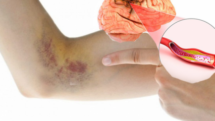 Forårsager koagulafladning? Hvad er symptomerne på fjernelse af blodpropper, og er der behandling?
